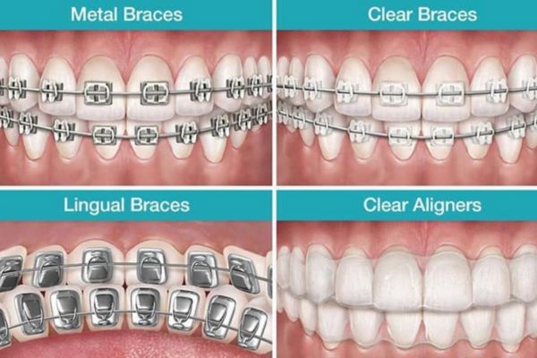 Braces