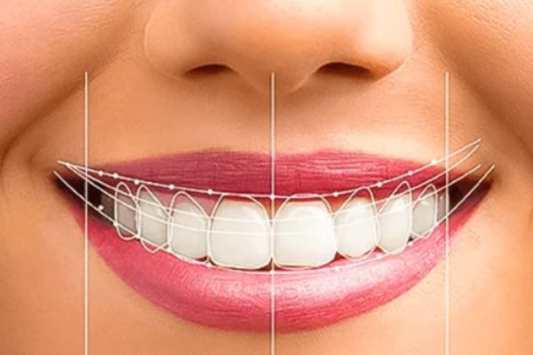 Smile Designing 