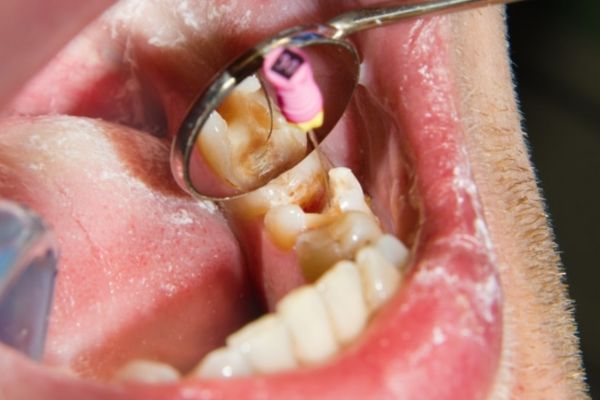 Root Canal